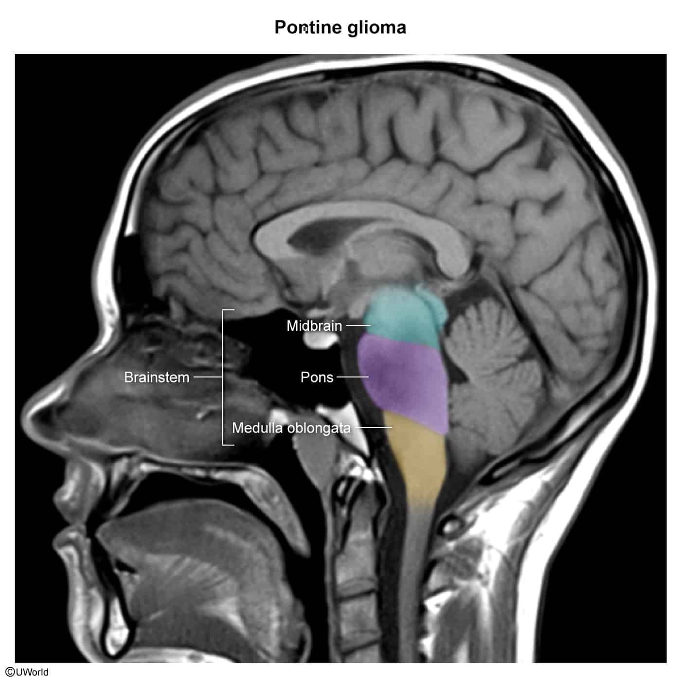 Pontine glioma