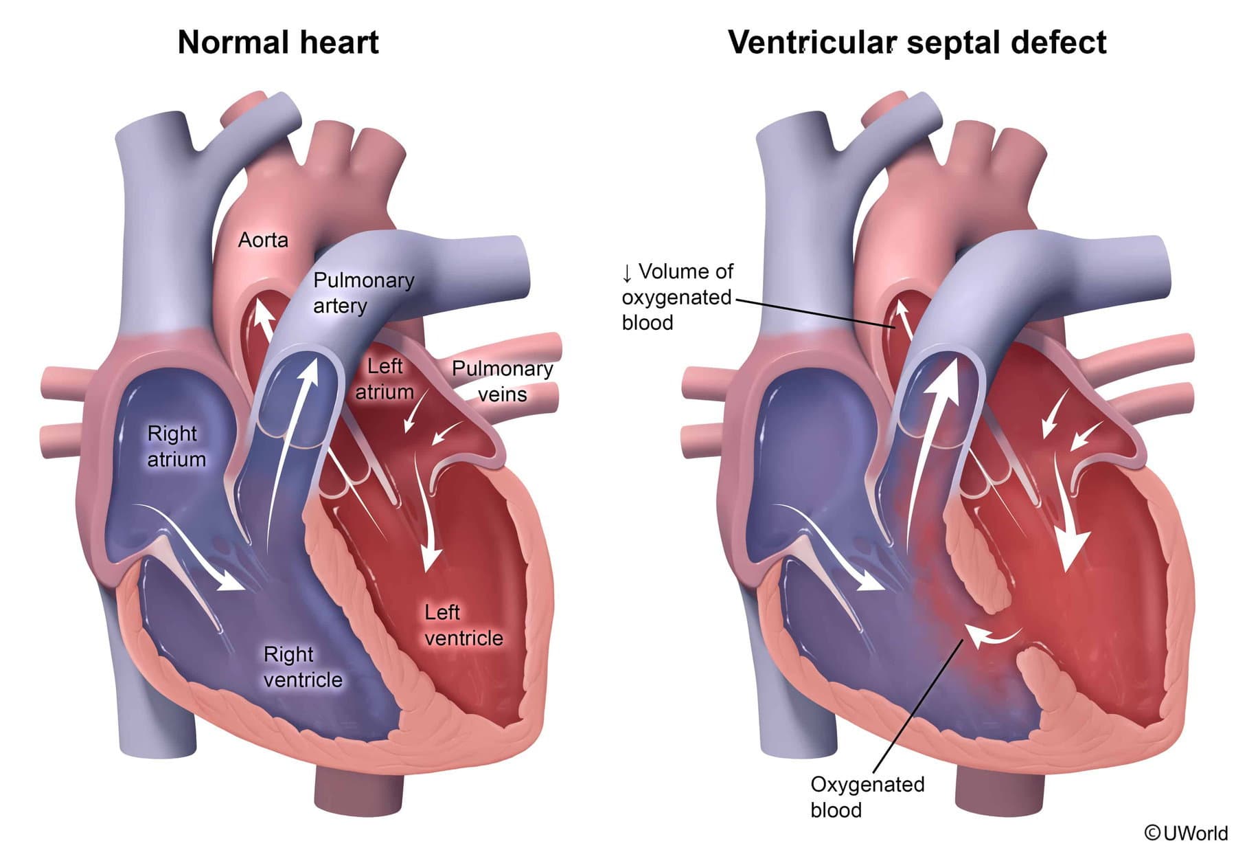 Ventricular septal defect