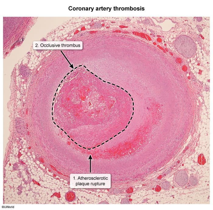 Coronary artery thrombosis